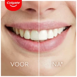 Max White Ultimate Led Whitening Kit 1 set^Colgate Best