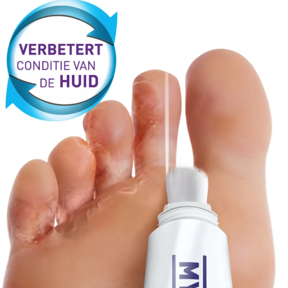 Wratten & Schimmels<Mycosan Behandelset Gel Voetschimmel 15 ml